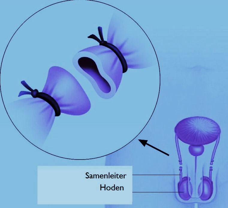 Dr. med. Daniel Münch Ligature (vasectomie)